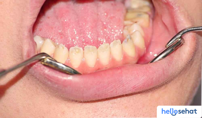 Rahasia Perawatan Gigi: Atasi Hipoplasia Enamel Secara Alami