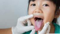 Waspadai 5 Gejala Kandidiasis Oral: Infeksi Jamur di Mulut