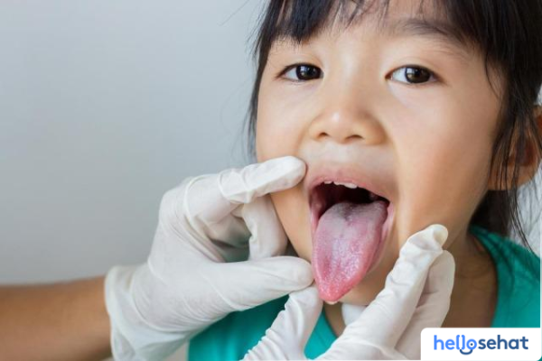 Waspadai 5 Gejala Kandidiasis Oral: Infeksi Jamur di Mulut Anda